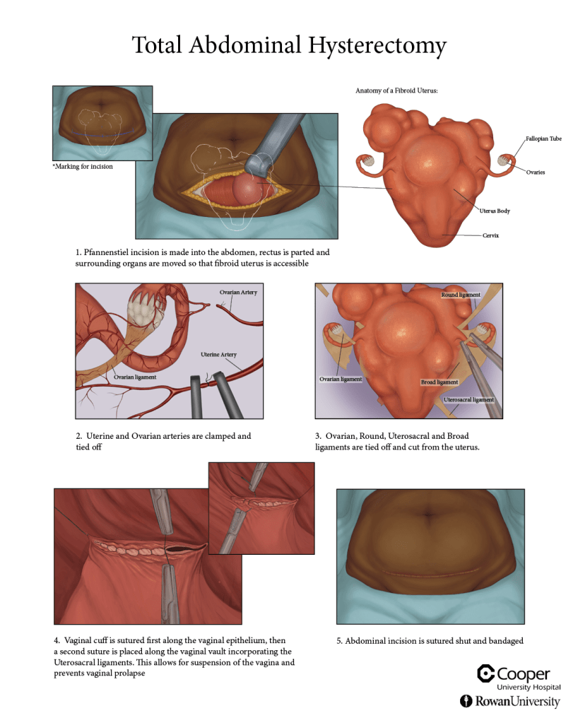 Abdominal fibroid hysterectomy, Photoshop and InDesign 