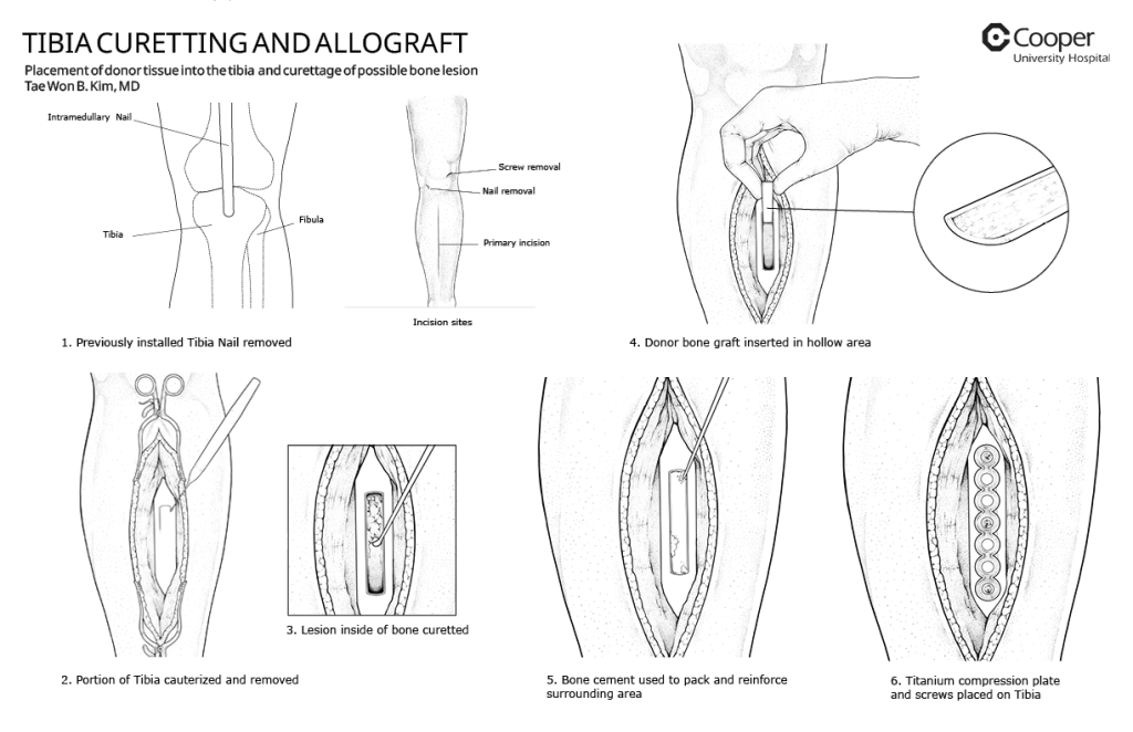 Tibia allograft, Photoshop and InDesign 